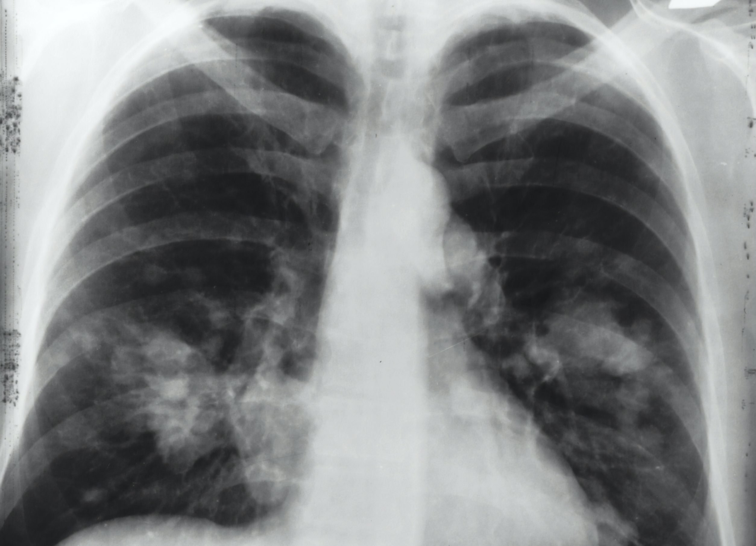 Global Study Finds Asbestos to Be Leading Cause of Lung Cancer in the Workplace