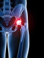 NYC Depuy Hip Replacement