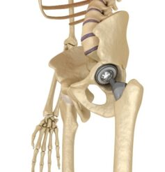 metal on metal hip replacement surgery lawsuit