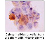 mesothelioma_cells1