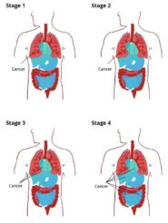 stages-mesothelioma