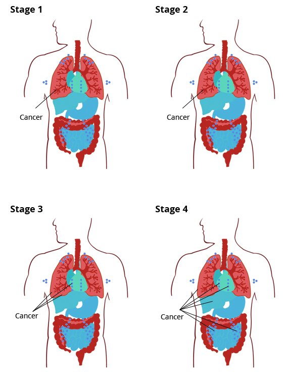 asbestos cancer stages